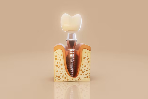 Implants