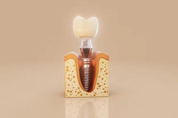 Implants