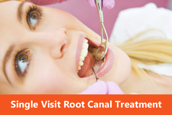 Single Sitting Root Canal Treatment 