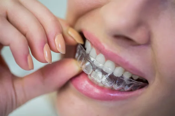 Invisible Braces Treatment